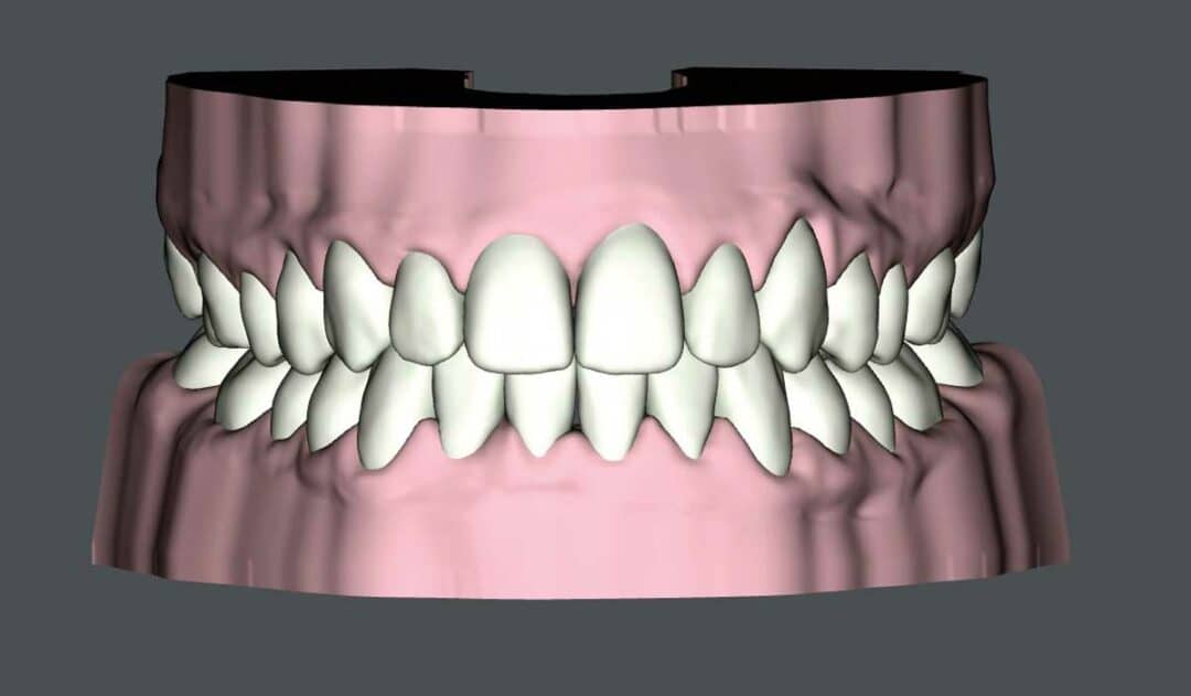 SureSmile Aligners and the Class I with Moderate Class III Pattern ...