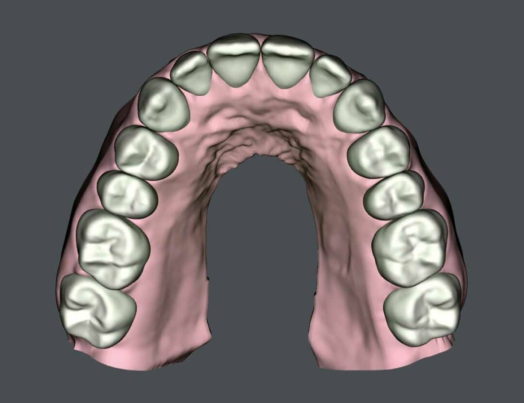 SureSmile Aligners and the Class I with Moderate Class III Pattern ...