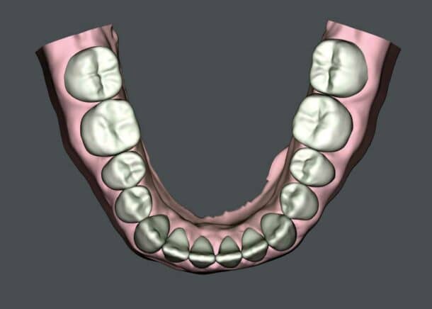 SureSmile Aligners and the Class I with Moderate Class III Pattern ...