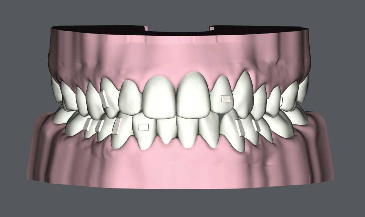 SureSmile Aligners and the Class I with Moderate Class III Pattern