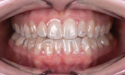 SureSmile Aligners and the Class I with Moderate Class III Pattern