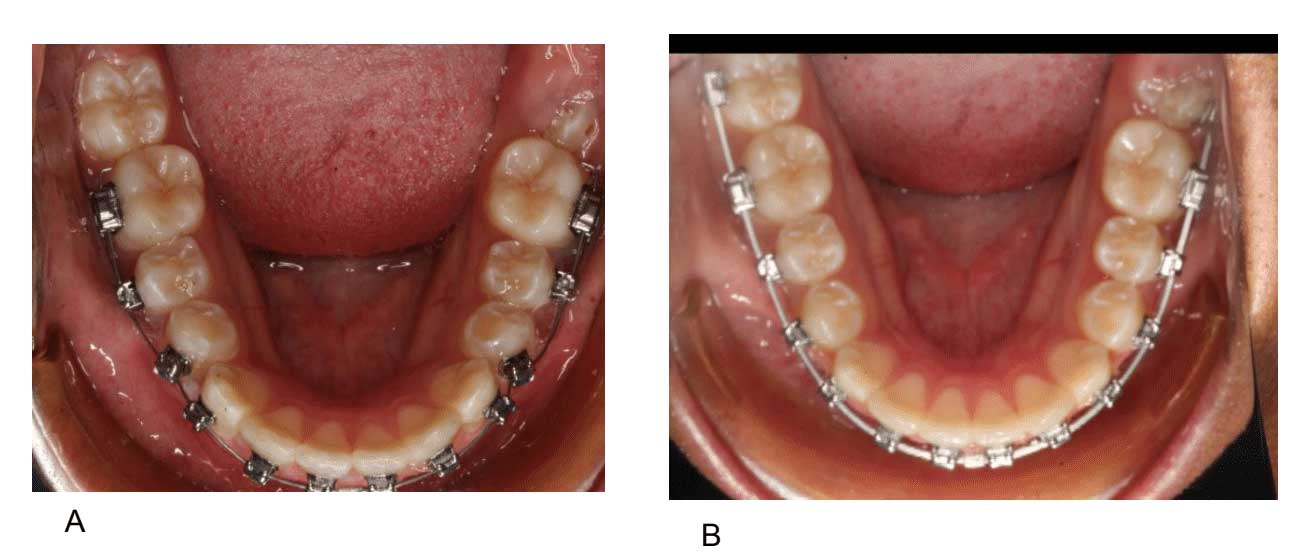Evaluating the Damon Ultima System’s New Passive SelfLigating Bracket