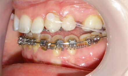 Gestenco Offers Freddy Ceramic Button and Hook for Aligner Treatment