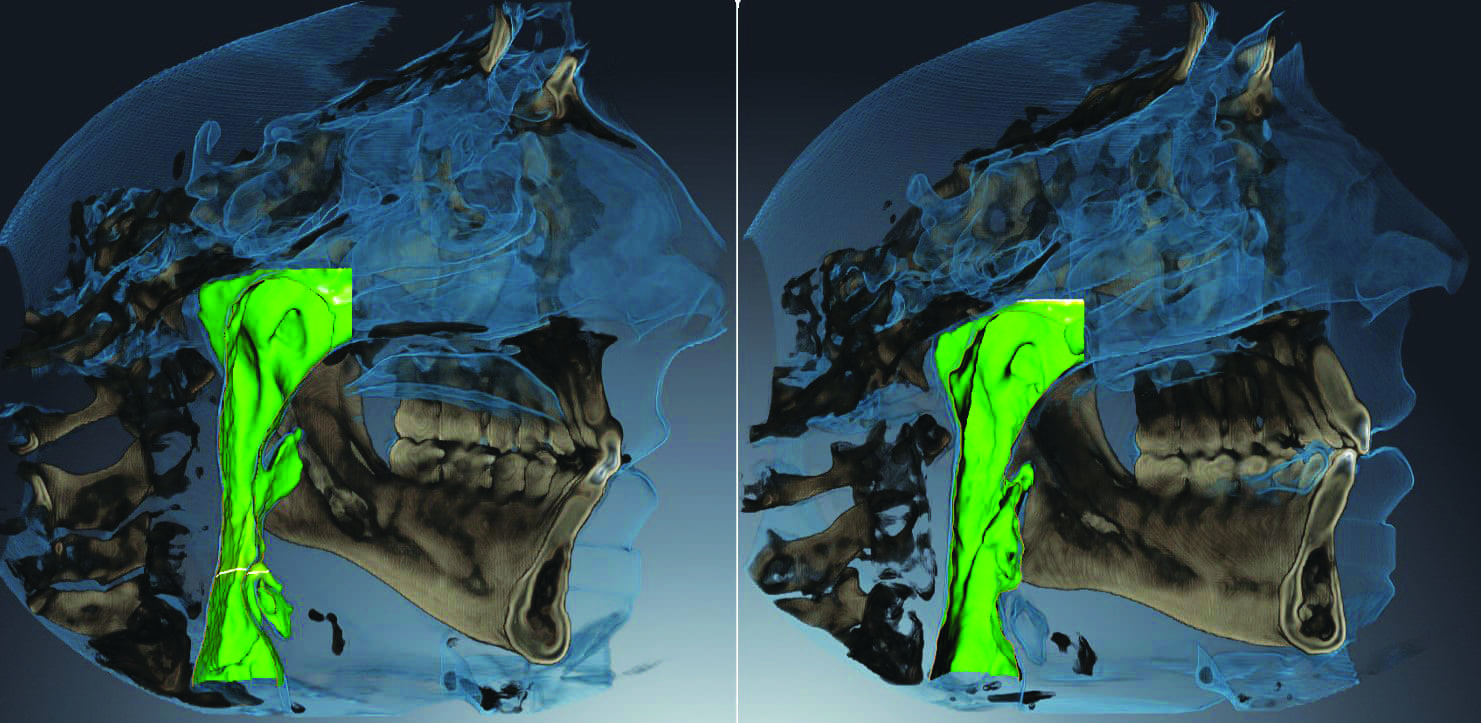 Teledontic-Telegnathic Technology: When Malocclusion And Obstructive ...