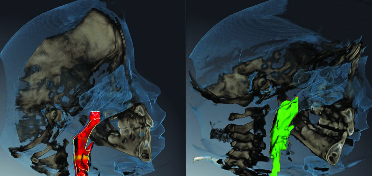 Teledontics-telegnathics: When Malocclusion & Sleep Apnea Meet