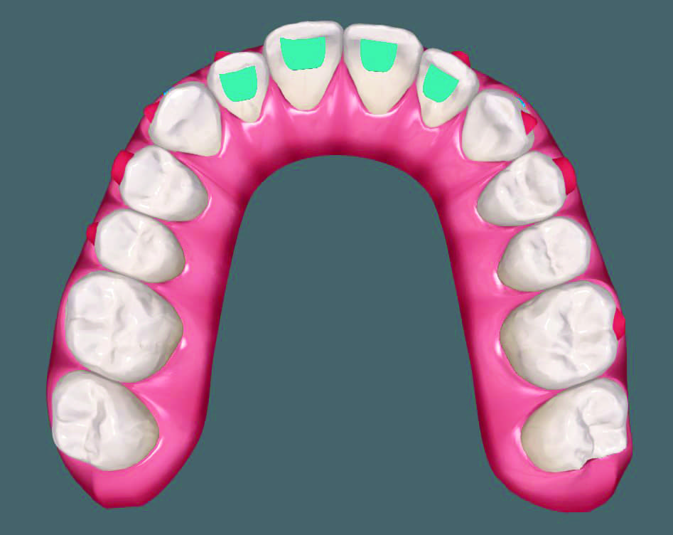 Invisalign precision bite ramps