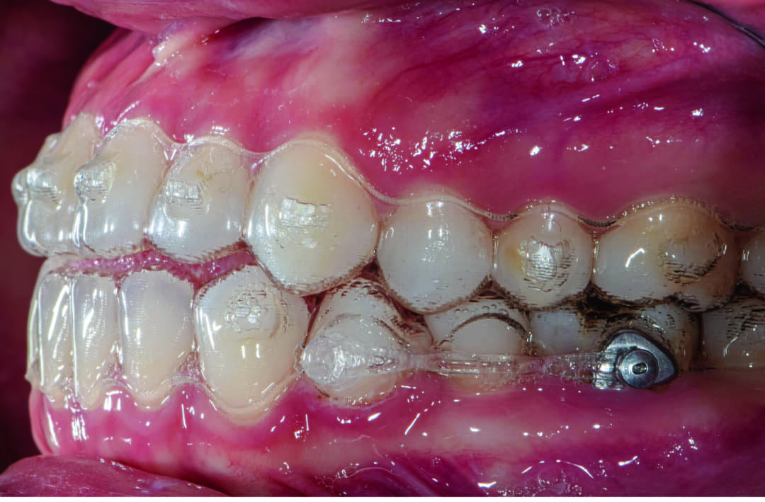 Incorporating Button Auxiliaries with Aligners for Severe Rotations