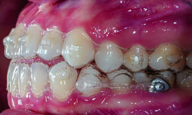 Clinical Pearl: Incorporating Button Auxiliaries with Aligners for Severe Rotations