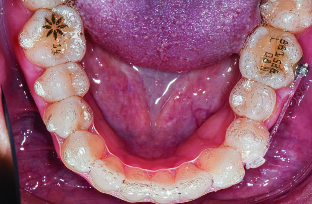 Clinical Pearl Incorporating Button Auxiliaries with Aligners for