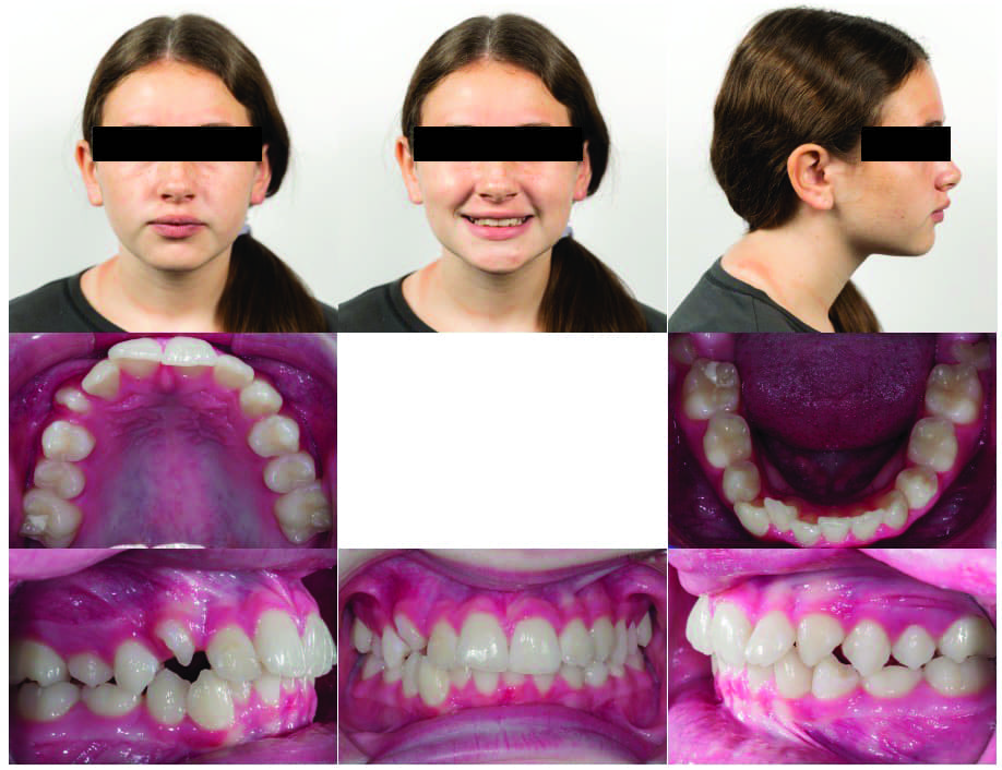 Incorporating Button Auxiliaries with Aligners for Severe Rotations