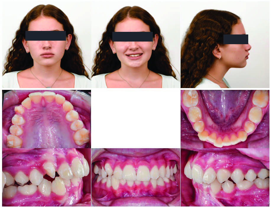 Incorporating Button Auxiliaries with Aligners for Severe Rotations