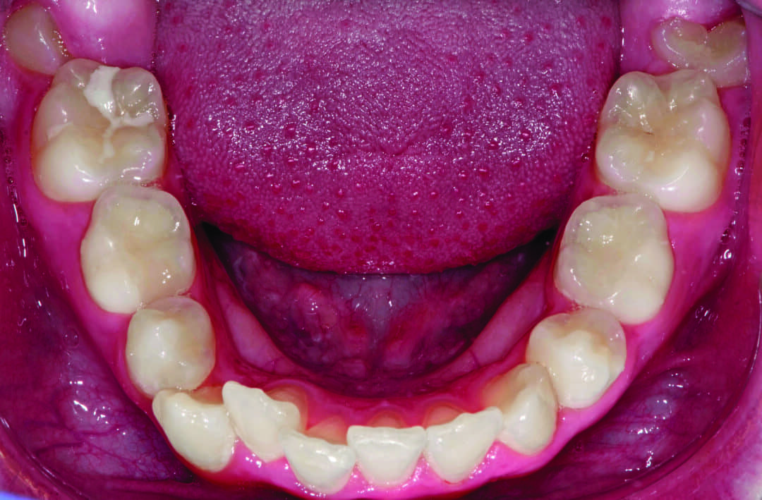 Incorporating Button Auxiliaries with Aligners for Severe Rotations