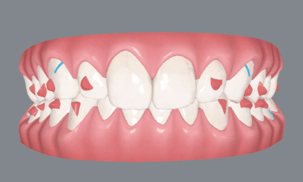 Dr Glaser’s 10 Commandments of Invisalign Treatment Design Revisited