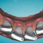 Clinical Pearl: Creating Space When Planning Clear Aligner Mechanics