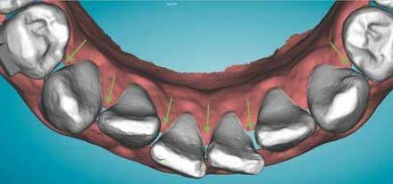 Clinical Pearl: Creating Space When Planning Clear Aligner Mechanics