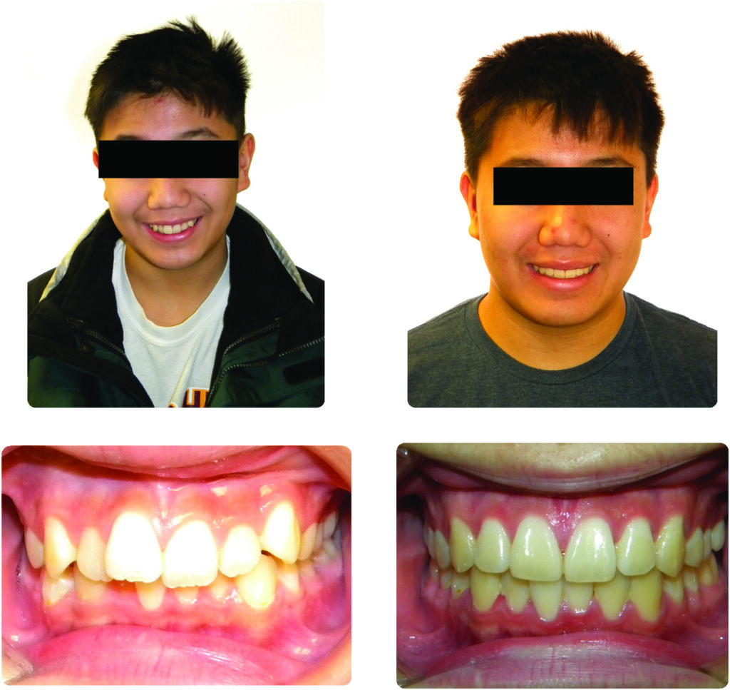 Incorporating Button Auxiliaries with Aligners for Severe Rotations