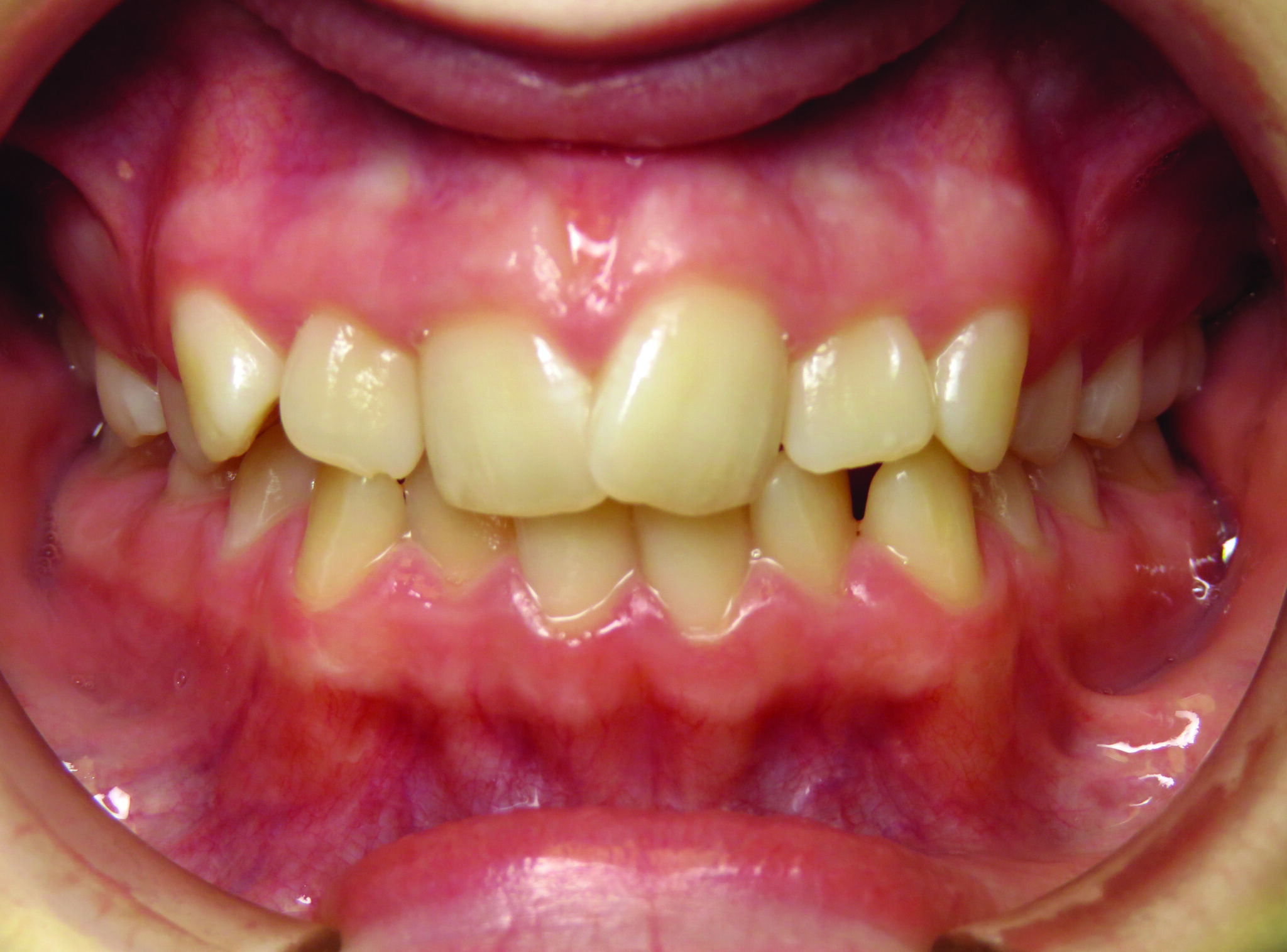 The Clear Difference Achieving Fewer Refinements with Aligners