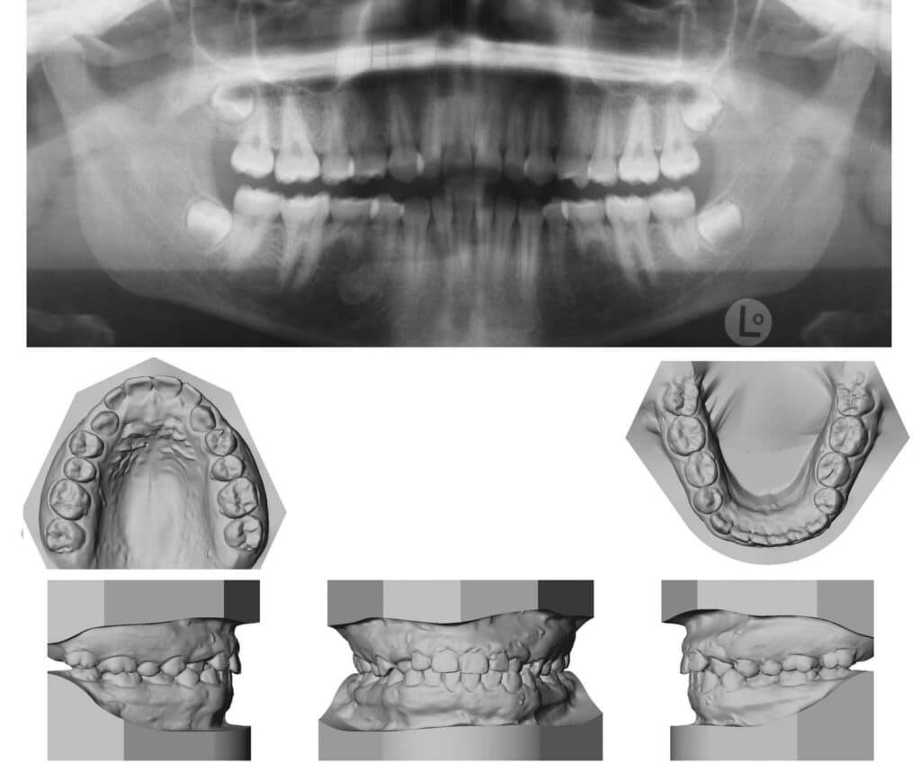 Figure 1: Initial pan and study model records for patient at age 15.5 years.