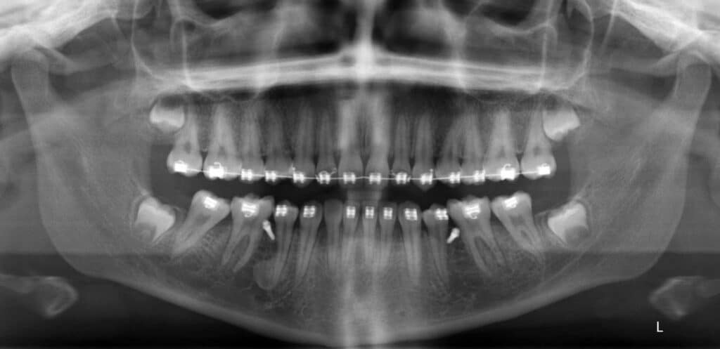 Figure 2: Progress pan showing TAD anchors in place for patient at age 17 years (no models taken at this time point).