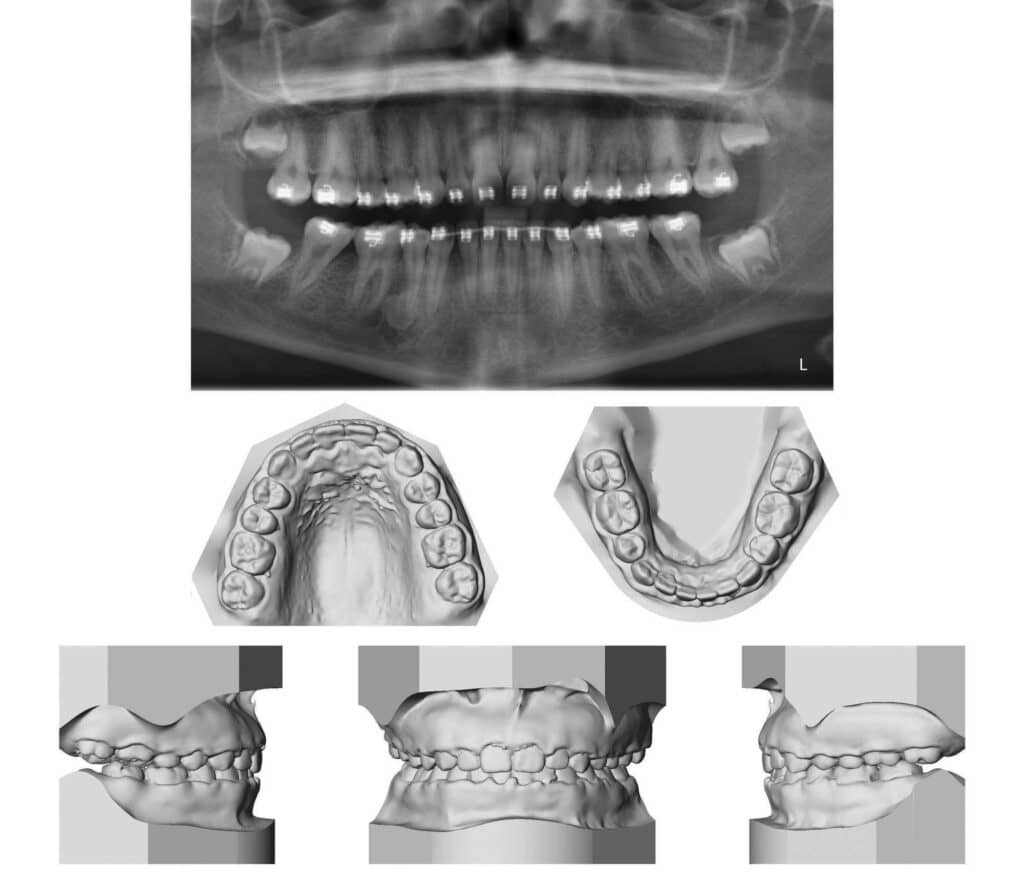 Figure 3: Pan and final study models for patient at age 18.5 years. Total active treatment time in braces 34 months.
