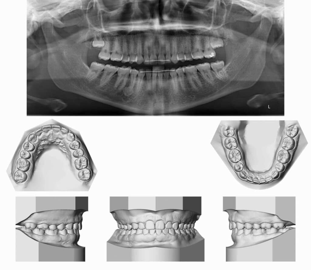 Figure 4: Follow-up records for patient at age 20.3 years. Pan and study models showing erupted teeth 38/48 (FDI tooth numbering system).
