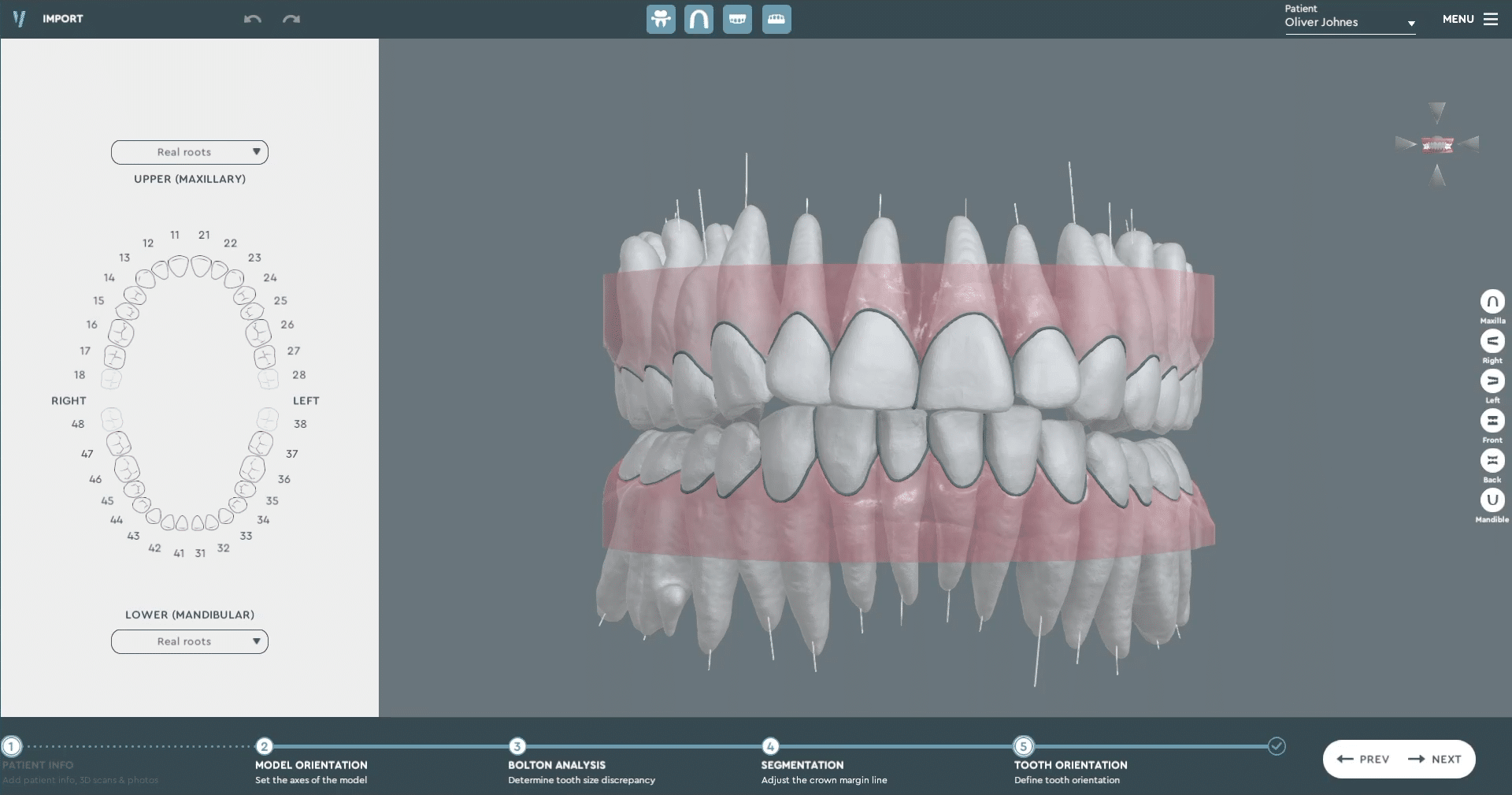 SoftSmile Integrates CBCT Analysis Into Vision | Orthodontic Products