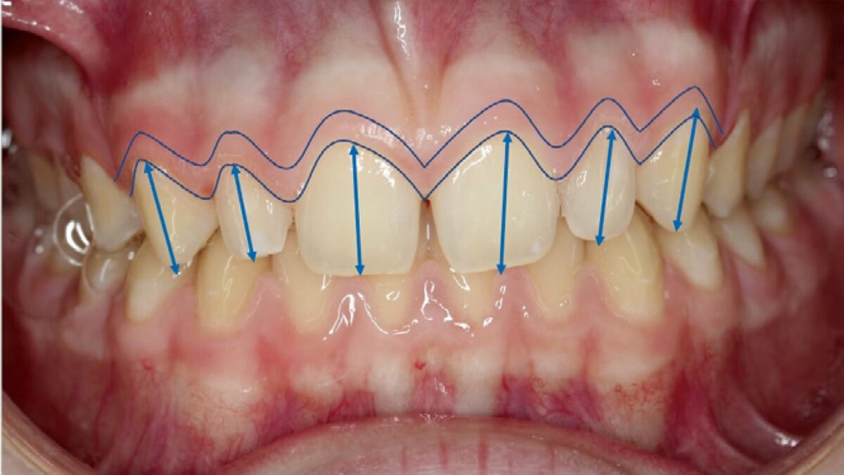 Dental-Laser-Teeth-1200x675.jpg
