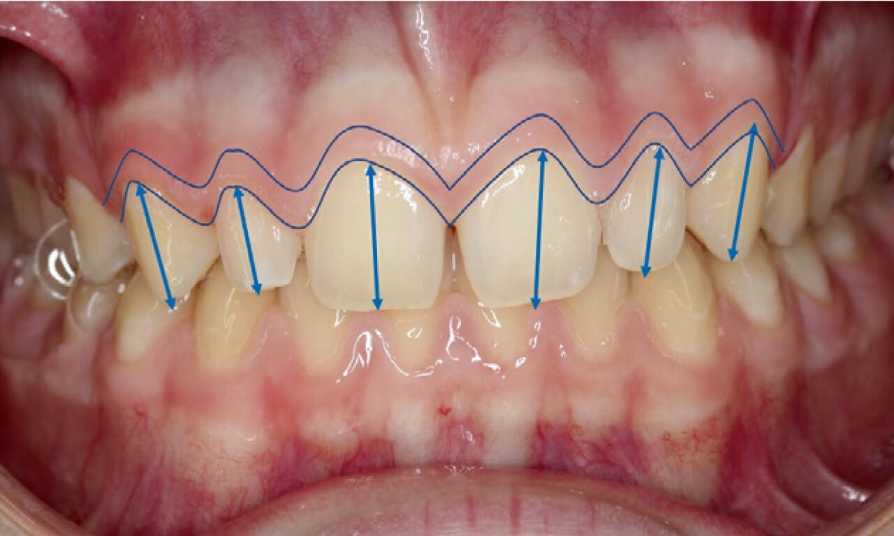 How Dental Lasers Allow for Better Adolescent Treatment