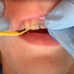 Closing up a Diastema Between Upper Central Incisors