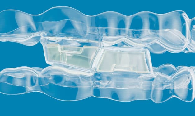 Align Launches Invisalign With Mandibular Advancement, featuring Occlusal Blocks, for Class II Treatment