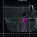 Airway Friendly Orthodontics Part 3: Anterior-Posterior Solutions