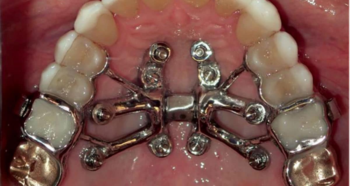 Airway Friendly Orthodontics Part 2: Transverse Treatment