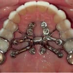 Airway Friendly Orthodontics Part 2: Transverse Treatment