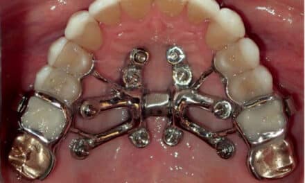 Airway Friendly Orthodontics Part 2: Transverse Treatment