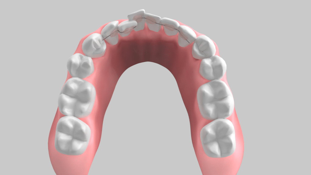 Alta Smiles C5 Hidden Orthodontics Prowires