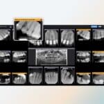 New Pearl Software Flags Dental Radiograph Errors at Time of Capture