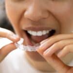 New Medit Aligners Now Available Through Medit Orthodontic Suite