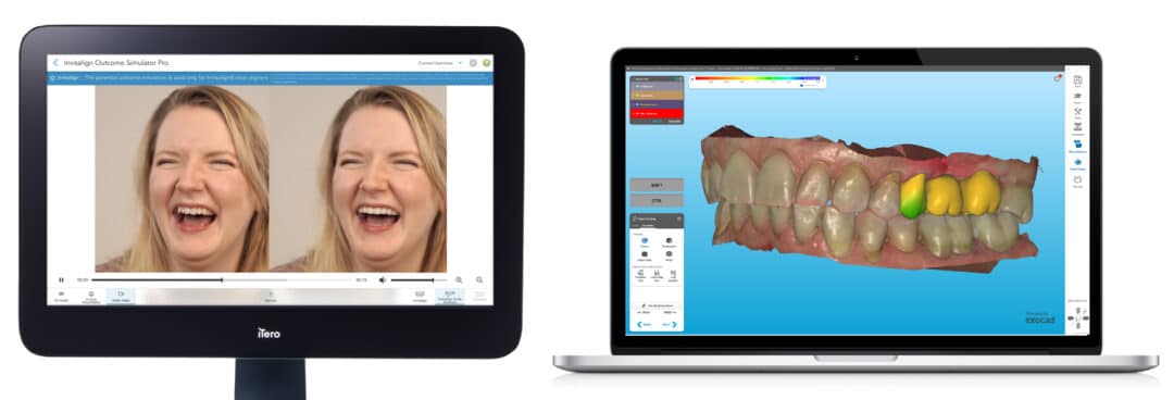Align Launches ClinCheck Live Plan and iTero System Updates