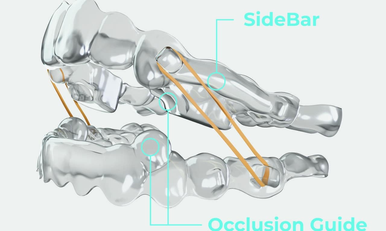 Navigating the Class II Malocclusion with a Single System