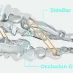 Navigating the Class II Malocclusion with a Single System