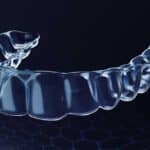 A Closer Look at OrthoFX’s PrecisionFinish Aligners and Their Clinical Impact