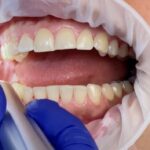 Geistlich Introduces Latex-Free Retractor for Dental Procedures