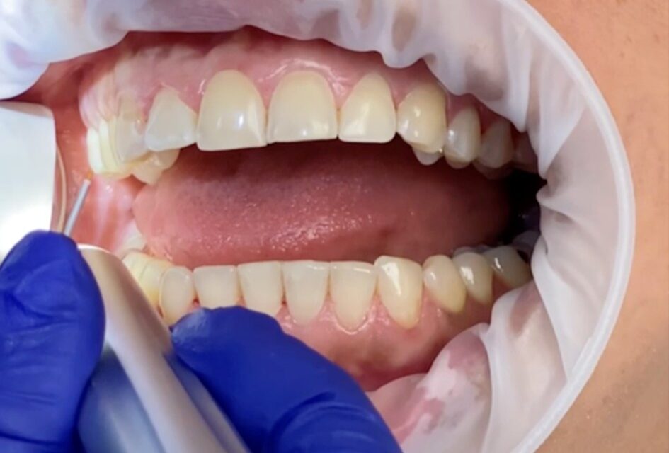 Geistlich Introduces Latex-Free Retractor for Dental Procedures