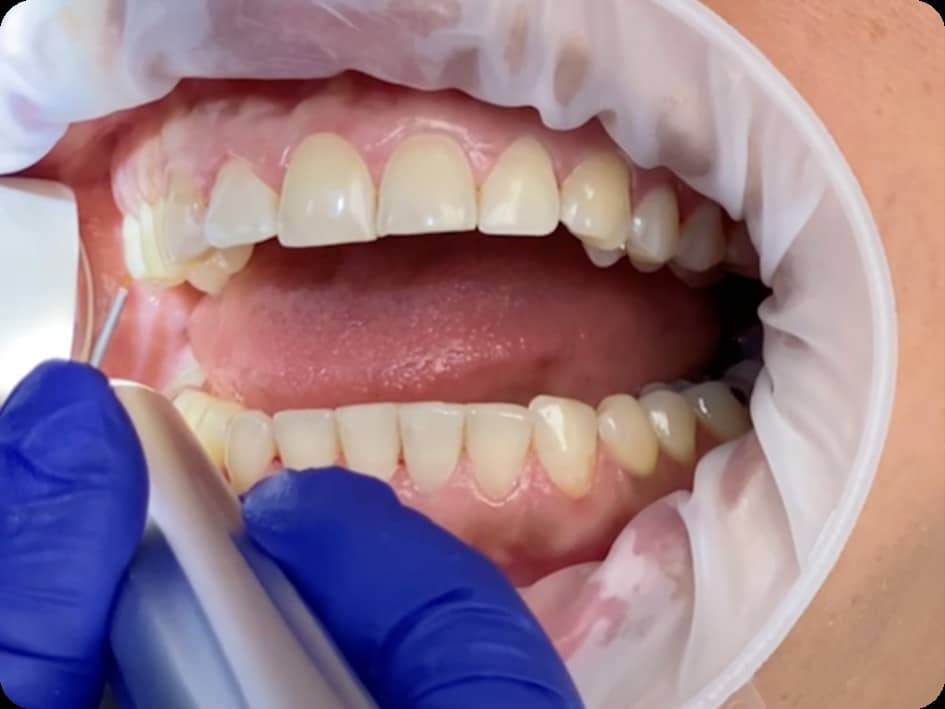 Geistlich Introduces Latex-Free Retractor for Dental Procedures