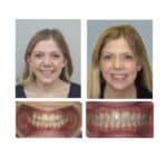 Correcting the Crossbite That Two Expanders Couldn’t