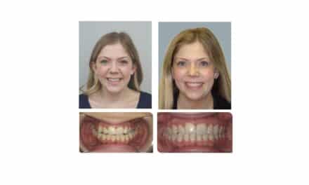 Correcting the Crossbite That Two Expanders Couldn’t