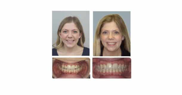 Before and After treatment with a MARPE and AirFlex PrecisionFinish aligners