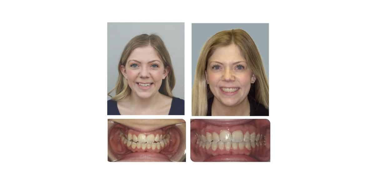 Correcting the Crossbite That Two Expanders Couldn’t