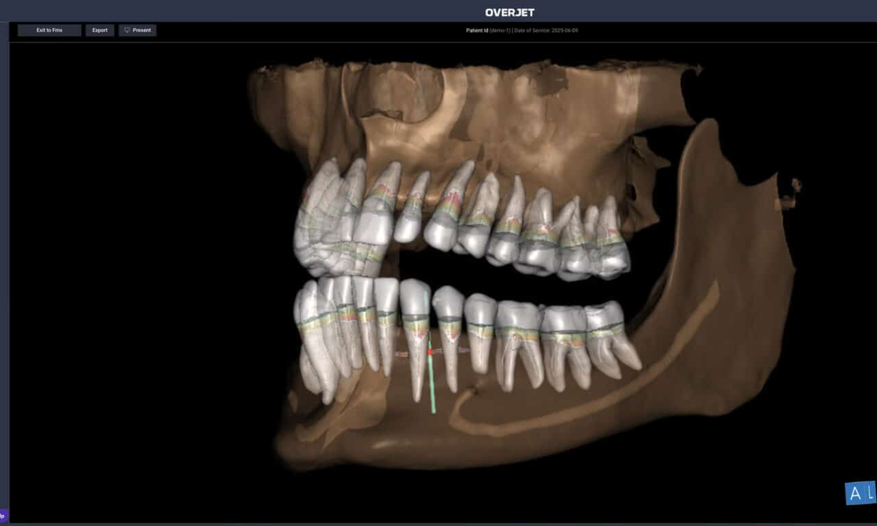 Overjet Secures FDA Clearance for CBCT Assist AI Platform