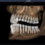 Overjet Secures FDA Clearance for CBCT Assist AI Platform